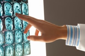 Doctor's finger pointing to brain MRI images
