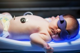 Baby receiving phototherapy for jaundice