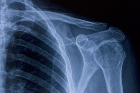 X-ray of shoulder showing collarbone injury