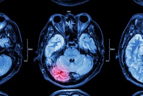 MRI image of brain identifying injury