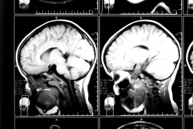 MRI scan of brain injury in premature baby
